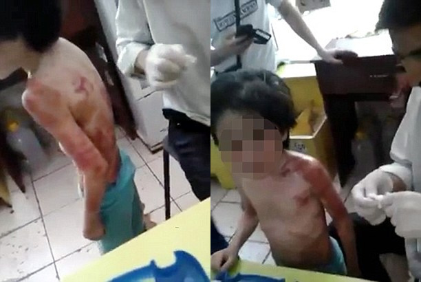 Chấn động bé 6 tuổi bị mẹ đánh thâm tím khắp người