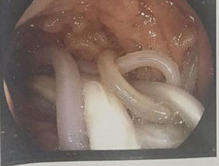 Kinh hoàng phát hiện từng búi giun chui lên tá tràng thai phụ