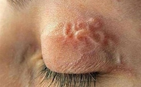 Bác sĩ kinh hãi vì giun sán 'bò' khắp cơ thể bệnh nhân